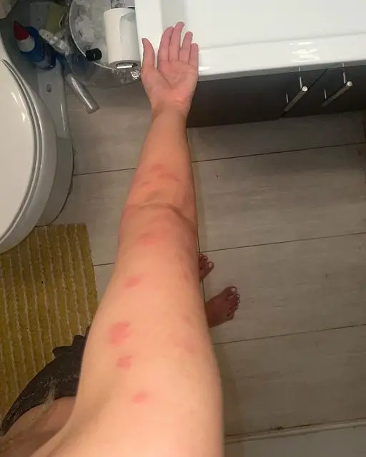 How to Identify Bug Bites: A Life-Saving Guide